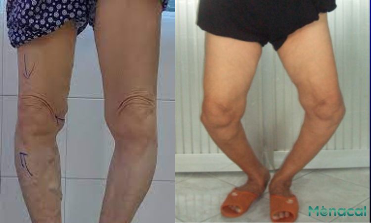 Thoái hóa khớp gối