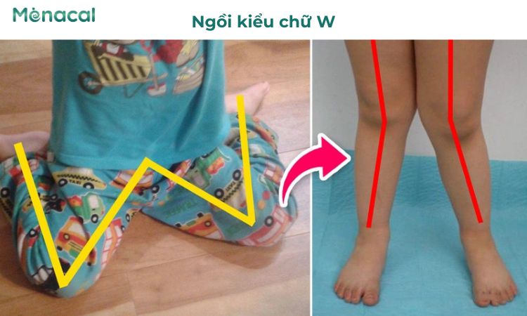 Ba mẹ nên quan tâm sửa tư thế ngồi của trẻ