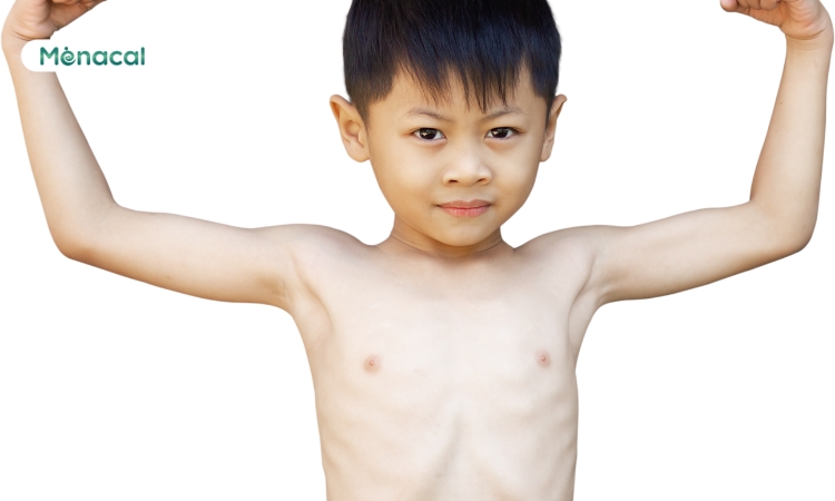 Còi xương là một nguyên nhân khiến trẻ bị chân vòng kiềng