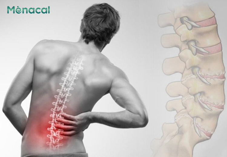Người bị loãng xương có thể bị gãy xương nhất là ở vùng hông và cột sống