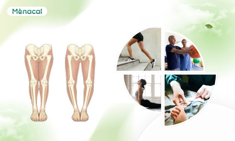 Các phương pháp chữa chân vòng kiềng phổ biến