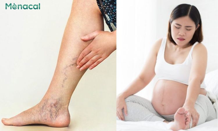 Mẹ bầu có thể bị nhức mỏi bắp chân về đêm do giãn tĩnh mạch